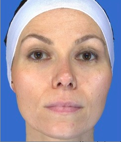 Chemical Peel