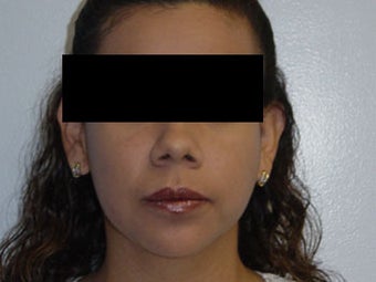 Chin Implants