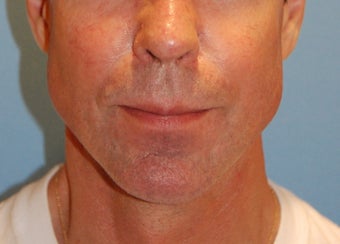 Jaw Augmentation with Implant