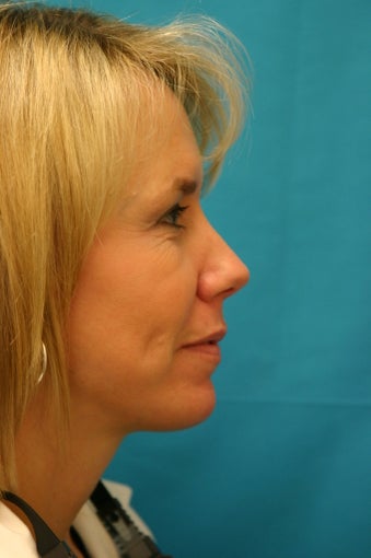 Chin Implant