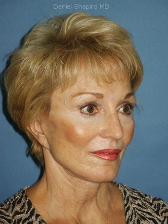 Chin augmentation with facial rejuvenation 