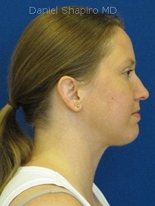Chin implant Exchange for a more contemporary size medium chin implant and  Necklift with 15cc of VASER liposuction of the neck.
