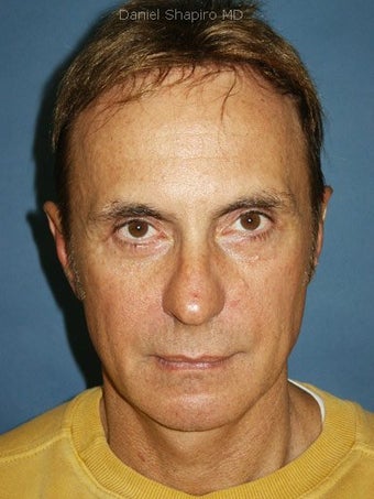 Chin augmentation, bilateral upper and lower blepharoplasty with canthopexy, and soft tissue fillers to the nasolabial folds 