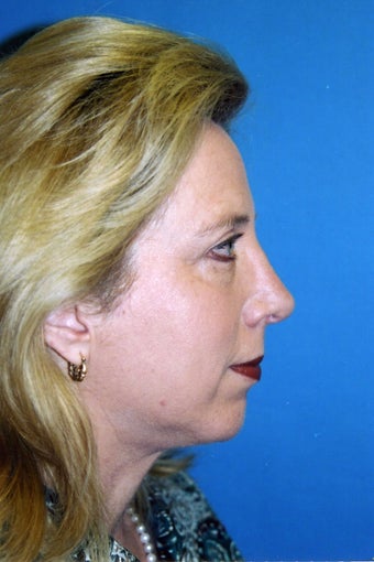 Chin Implant, Rhinoplasty