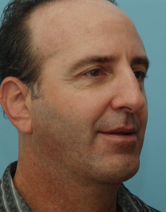 Chin Augementation