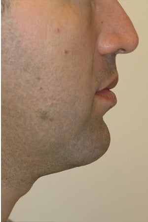 Chin augmentation, neck liposuction and neck muscle tightening.