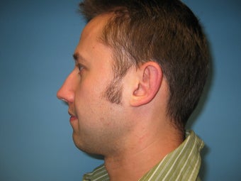 chin implant