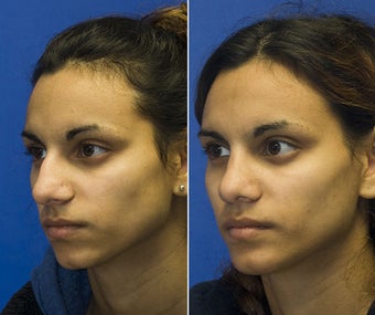 Chin Implantation with Rhinoplasty