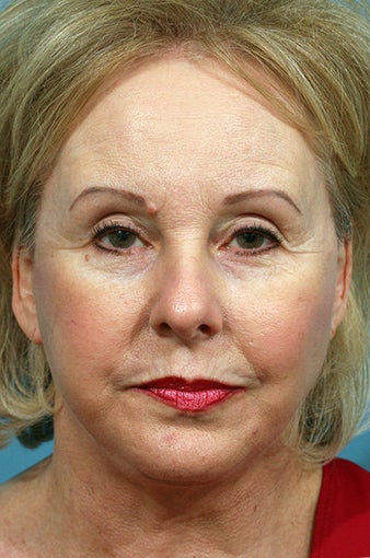 Chin Implant