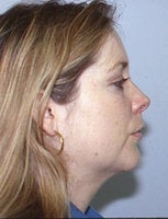 Before and After Chin Implant with Liposuction (Side View)