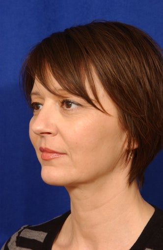 Neck-lace procedure with anatomic chin implant 