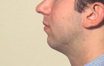 Chin implant