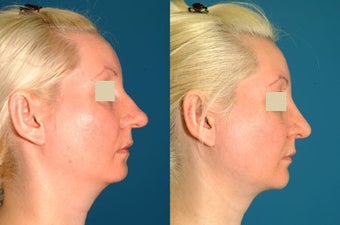 Rhinoplasty, Chin Implant, & Neck Liposution