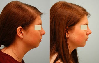 Chin Implant (Alloplastic Chin Augmentation)