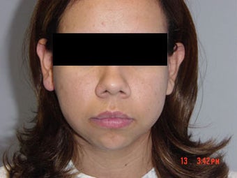 Chin Implants