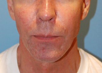 Jaw Augmentation with Implant