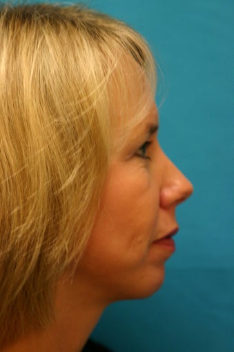 Chin Implant