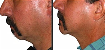 Chin Augmentation