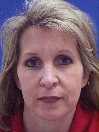 Chin Augmentation, Revision Rhinoplasty, and Facial Rejuvenation