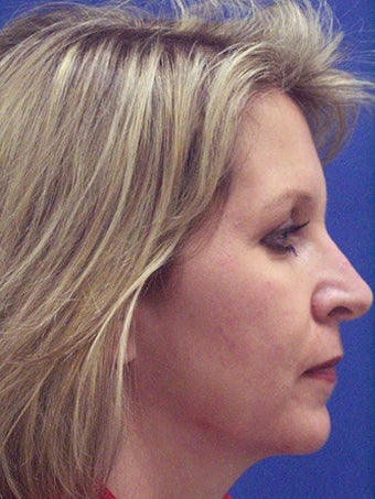  Chin Augmentation, Revision Rhinoplasty, and Facial Rejuvenation 