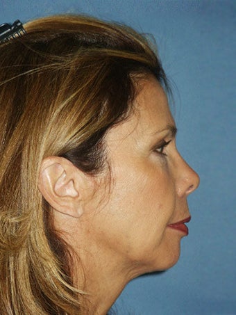 Chin augmentation with facial rejuvenation
