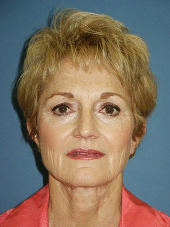 Chin augmentation with facial rejuvenation 