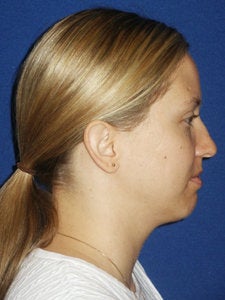 Chin implant Exchange for a more contemporary size medium chin implant and  Necklift with 15cc of VASER liposuction of the neck.
