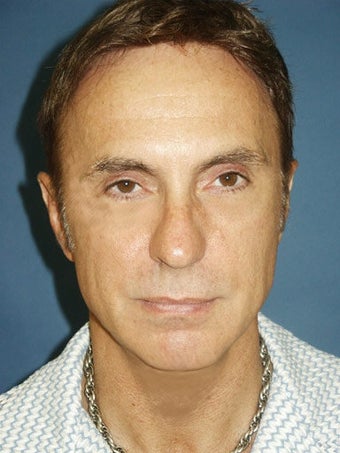  Chin augmentation, bilateral upper and lower blepharoplasty with canthopexy, and soft tissue fillers to the nasolabial folds 