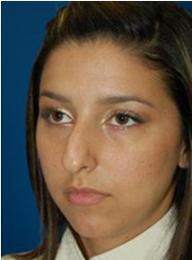 Chin Enhancement