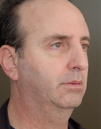 Chin Augementation