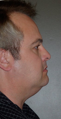 Chin Augementation