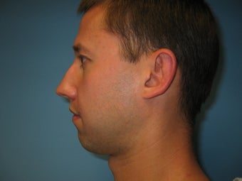 chin implant