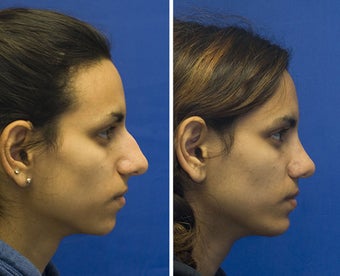 Chin Implantation with Rhinoplasty