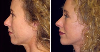 47 year old female, chin implant