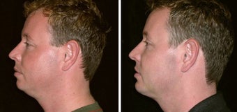 34 year old male, chin implant