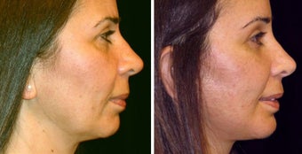 48 year old female, chin implant