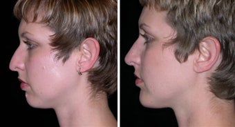 25 year old female, chin implant
