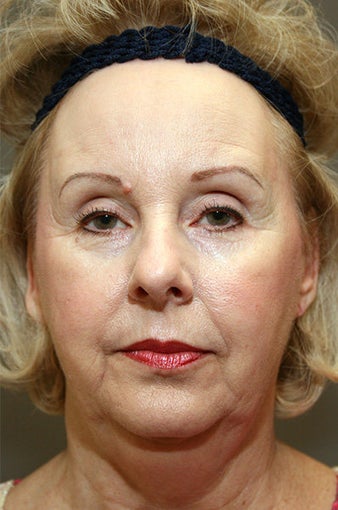 Chin Implant