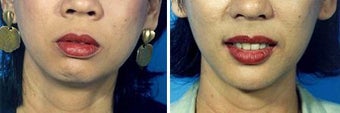 Chin Implant