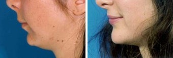 Chin Implant
