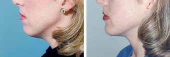 Chin Implant