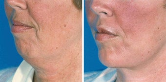 Chin Implant