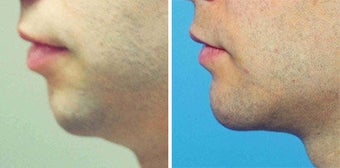 Chin Implant
