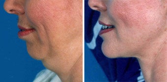 Chin Implant