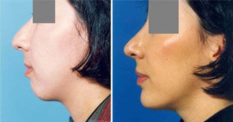 Chin Implant
