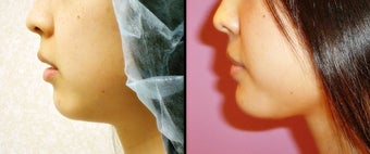 Chin Augmentation