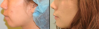 Chin Augmentation