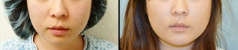 Chin Augmentation