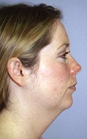 Before and After Chin Implant with Liposuction (Side View)