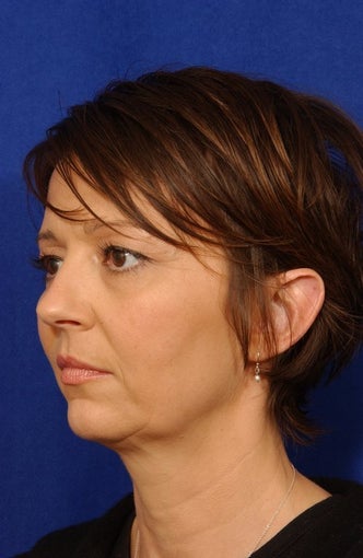 Neck-lace procedure with anatomic chin implant 